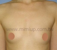 自體脂肪豐胸案例2 前