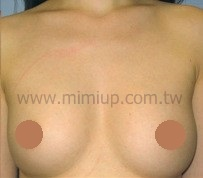 自體脂肪豐胸案例2 後