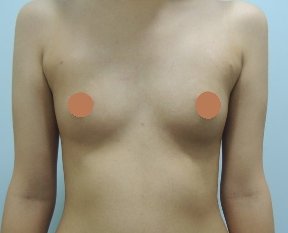 案例二：上胸無肉改善，打造自然水滴胸型術前照