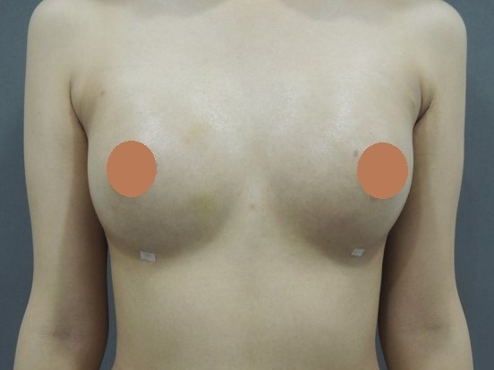 案例二：上胸無肉改善，打造自然水滴胸型術後照