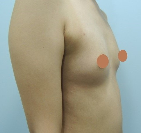 案例二：上胸無肉改善，打造自然水滴胸型  側面術前照