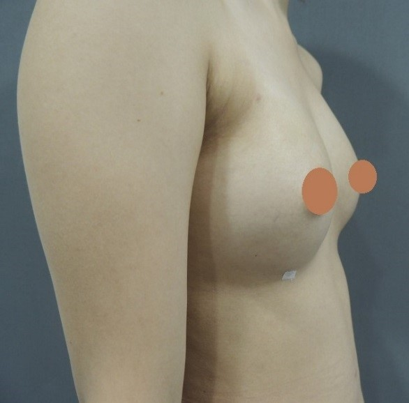 案例二：上胸無肉改善，打造自然水滴胸型  側面術後照