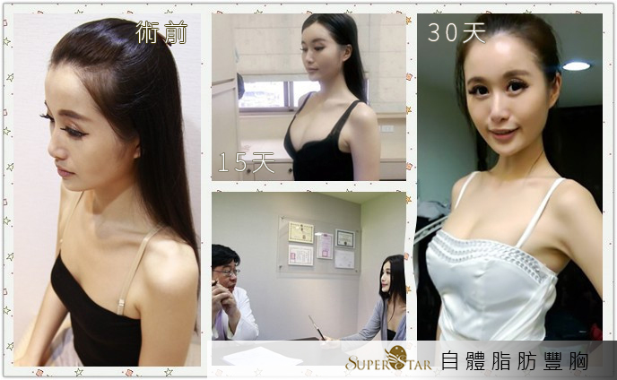 小靚術前術後照1