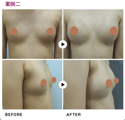 案例二 術前術後