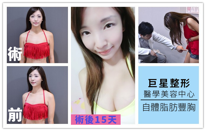 巨星整形術前術後照
