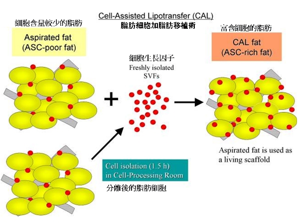 脂肪純化與生長因子輔助示意