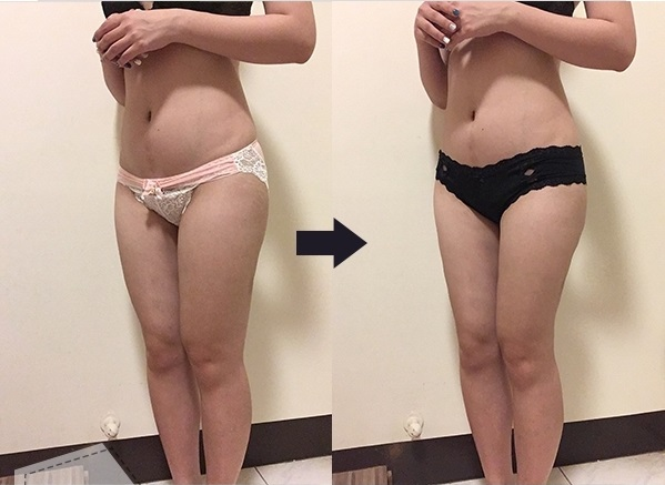 案例七：威塑 360 度環形抽脂 + 自體脂肪隆乳3