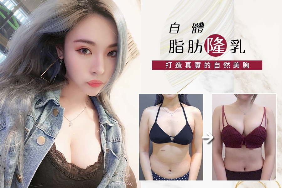 案例1：威塑自體脂肪隆乳