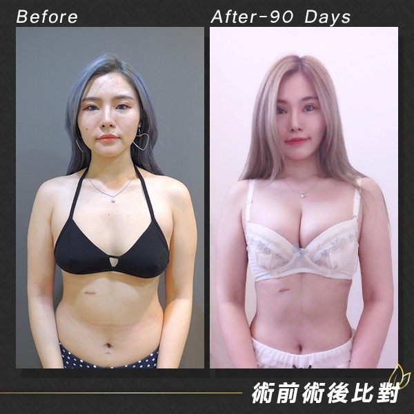 案例1：威塑自體脂肪隆乳 90天