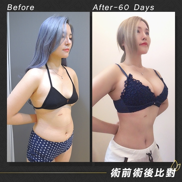 案例1：威塑自體脂肪隆乳 60天