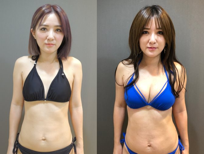 案例2：威塑自體脂肪隆乳 1