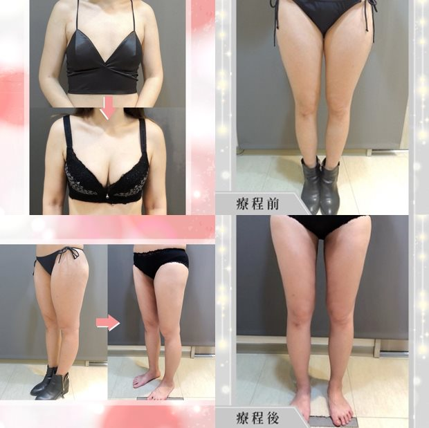 案例3： 威塑自體脂肪隆乳2