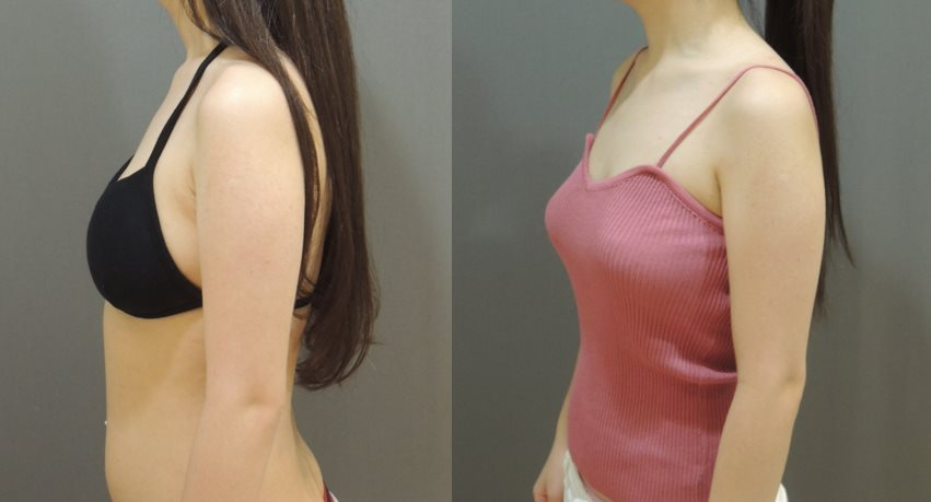 案例6：威塑自體脂肪隆乳1