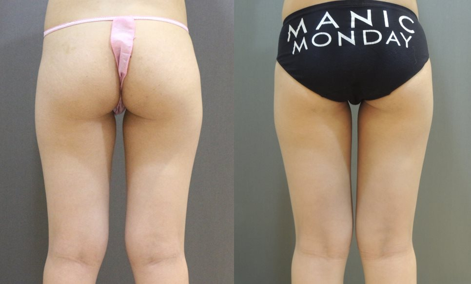 案例6：威塑自體脂肪隆乳4