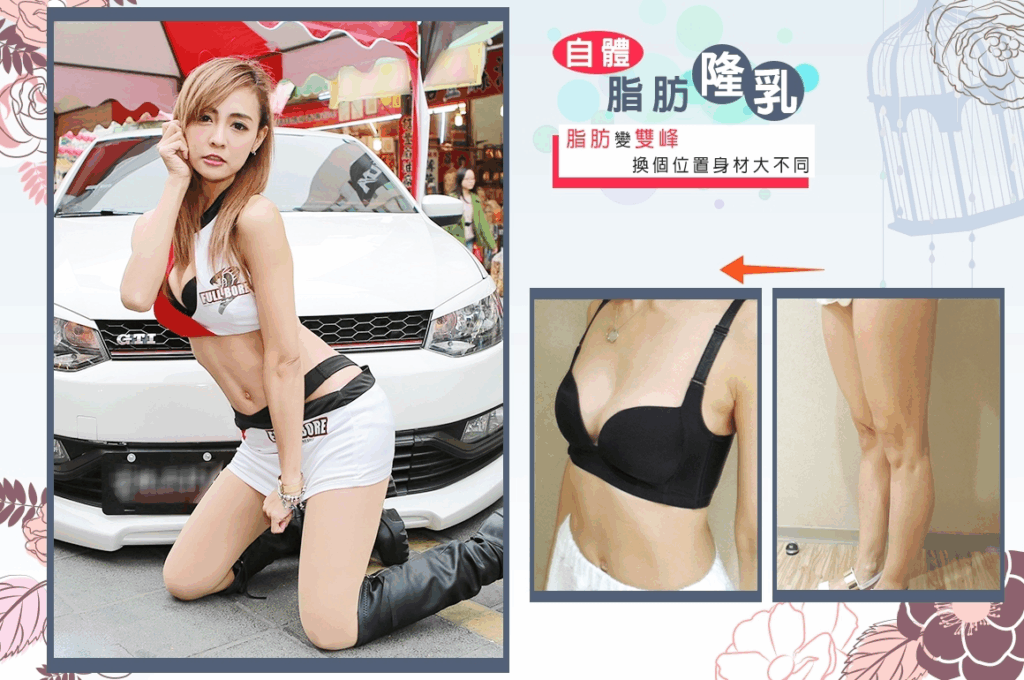 案例7：威塑自體脂肪隆乳 3