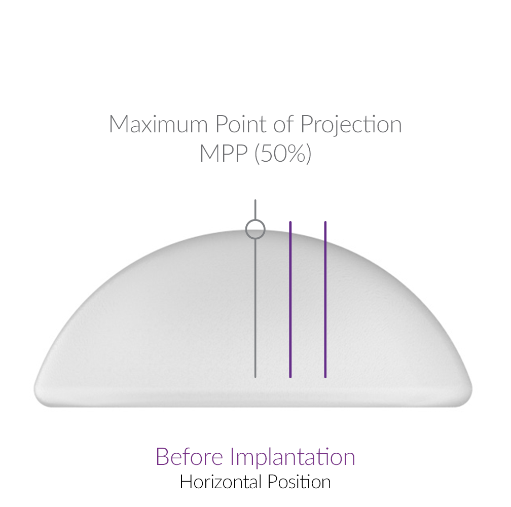 二代雙面複合式隆乳