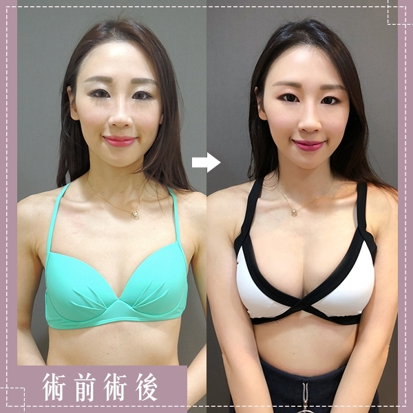案例1： 二代雙面複合式隆乳