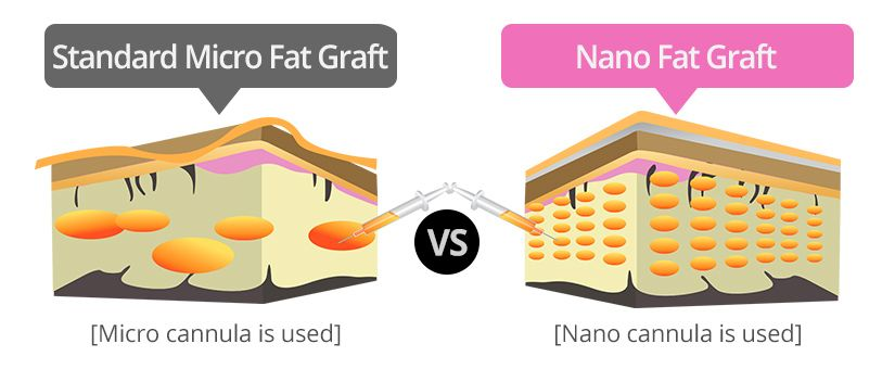 奈米脂肪填補示意