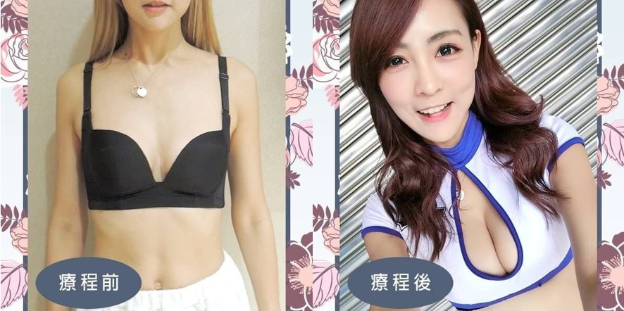 CASE 1 自體脂肪隆乳 (威塑大腿環狀抽脂)1