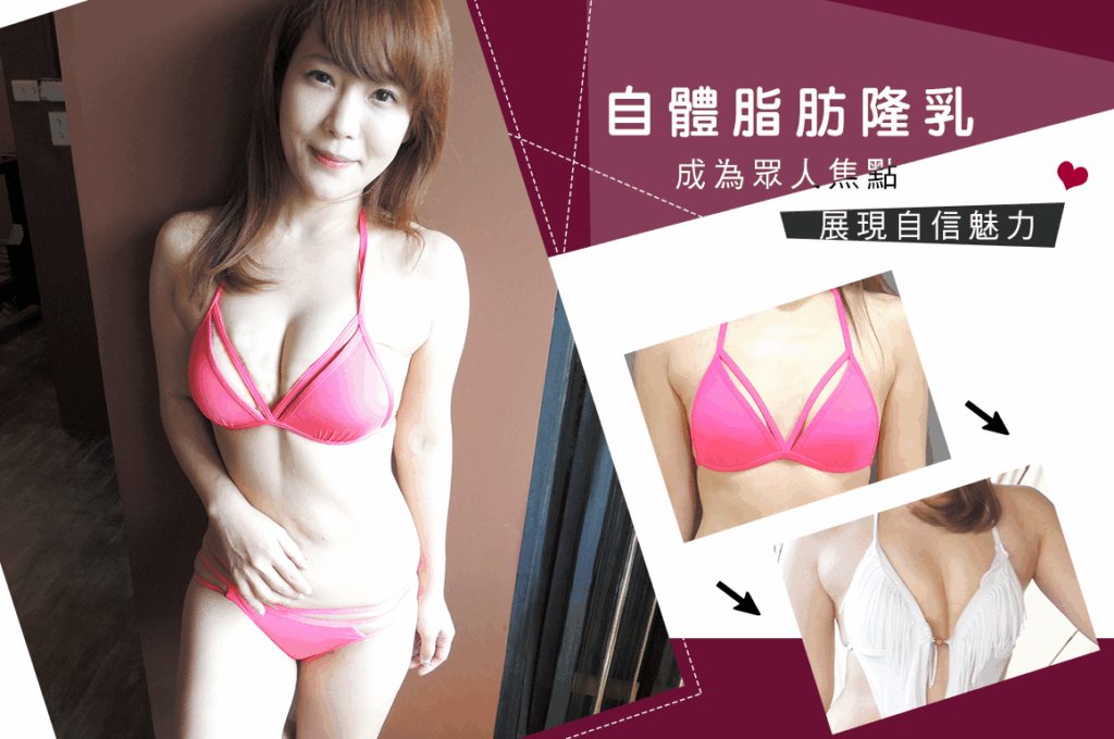 CASE 2 自體脂肪隆乳 (大腿抽脂)1