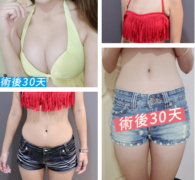 CASE 4 自體脂肪隆乳 (威塑腰腹環狀抽脂)