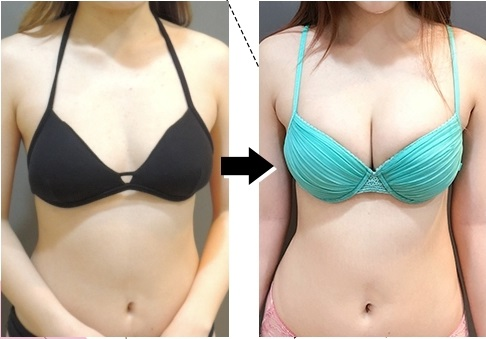 CASE 7  自體脂肪隆乳 (大腿抽脂)1