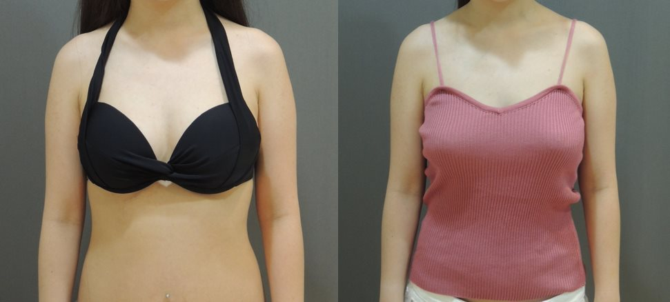 更多自體脂肪隆乳術後實拍1