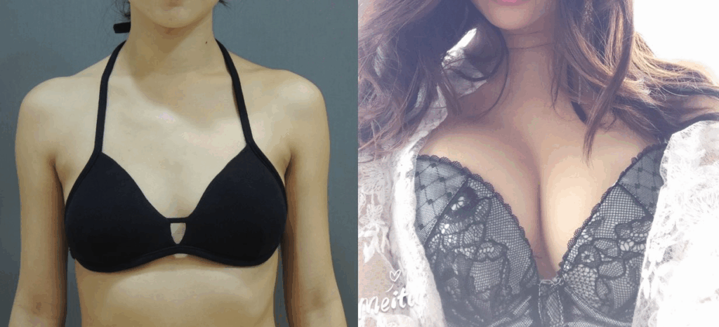 更多自體脂肪隆乳術後實拍3