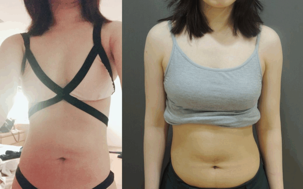 更多自體脂肪隆乳術後實拍4