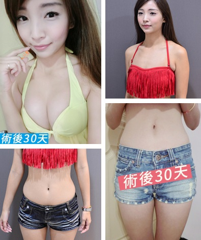 推薦分享：自體脂肪隆乳 + 局部雕塑