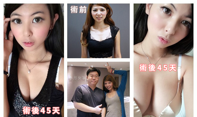 更多果凍矽膠隆乳案例分享2