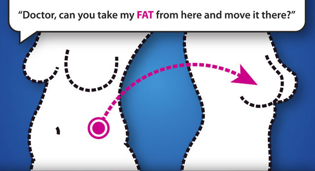 什麼樣的人適合自體脂肪隆乳？