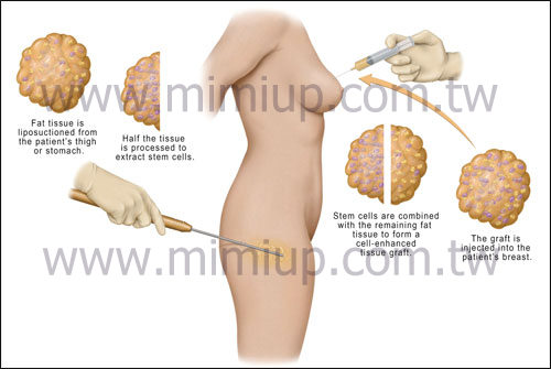 體脂肪隆乳
