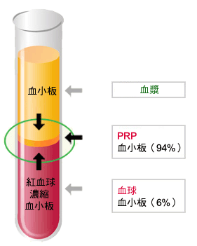  PRP（高濃度血小板血漿）