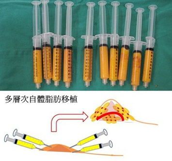 多點多層次施打
