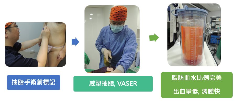 體脂肪隆乳手術流程 SOP2