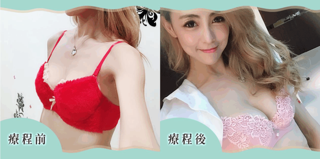 案例一：自體脂肪隆乳 + 大腿環抽