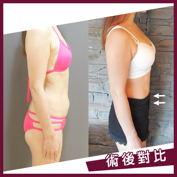 案例三：產後修復 + 腹部抽脂2