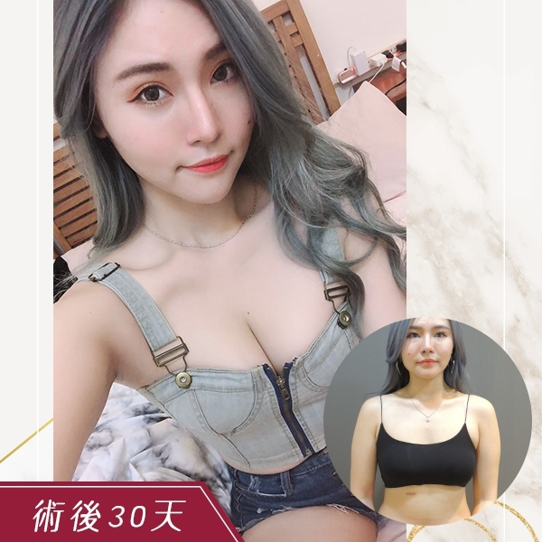 案例四：隆乳 + 威塑腹部抽脂 + 雕塑ㄦ字腰1