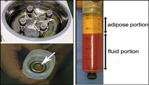 自體脂肪純化技術