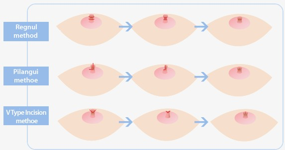 縮乳頭手術的三種常見方式