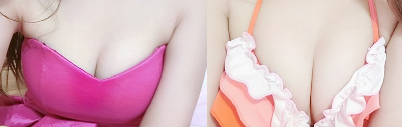 案例 1：深 V 形乳溝