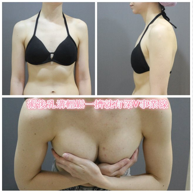 案例 7：深V形乳溝