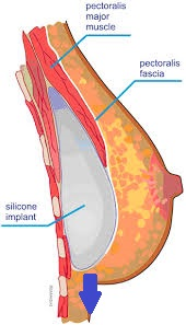 (二代雙面複合式隆乳原理，透過胸下緣放鬆創造水滴空間)