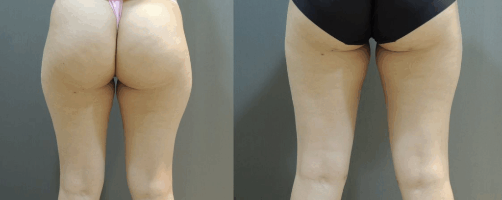 案例一：大腿環抽2