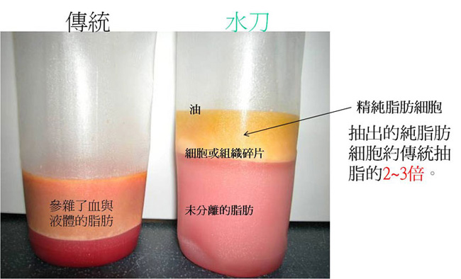傳統VS水刀抽脂