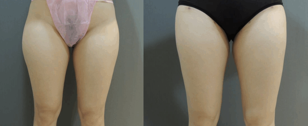 案例一：大腿環抽1