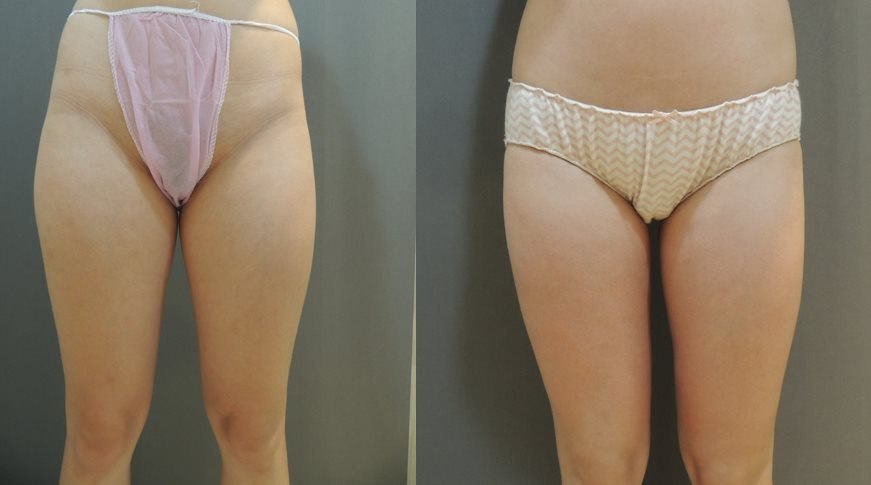 案例二：腹部/腰部抽脂1