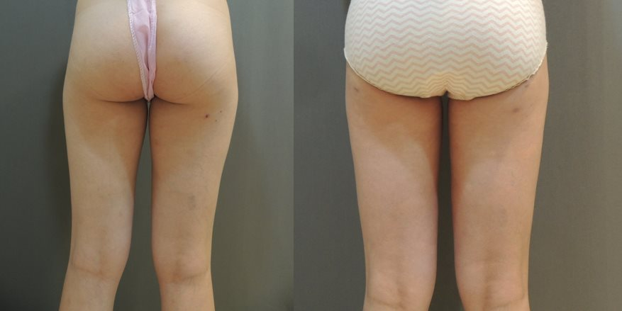 案例二：腹部/腰部抽脂2