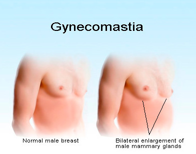 男性女乳症示意圖